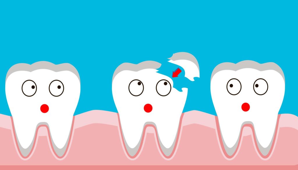 השלמת שן שבורה - ד"ר אבלין ושלר' רופאת שיניים המתמקדת בטיפול בחרדה דנטלית בילדים ומתבגרים
